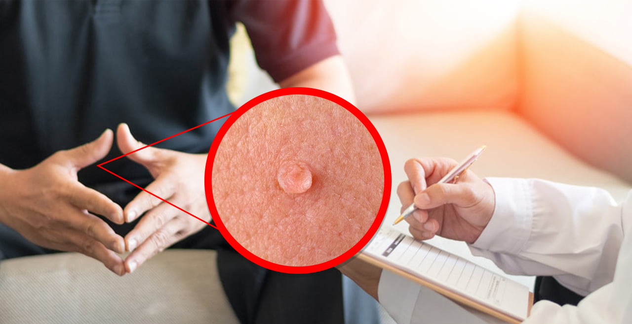 Say Goodbye to Genital Warts : How to Get Rid of Genital Warts Once and For All